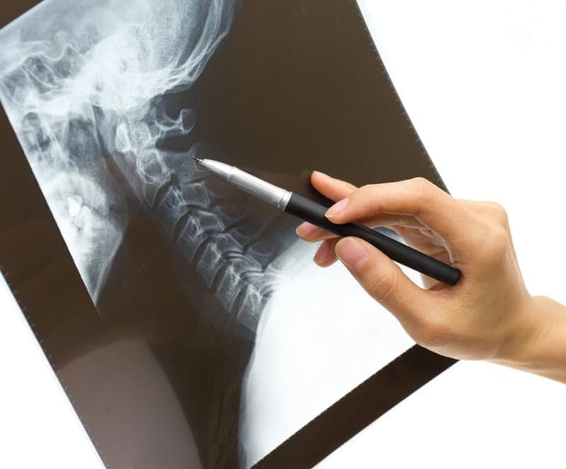 cervical spine location x-ray stock photo