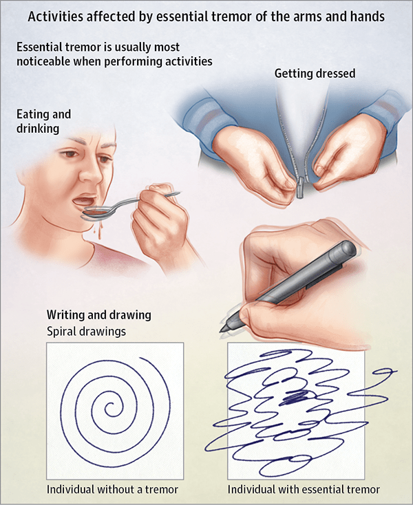 tyler, texas doctor specializing in essential tremors