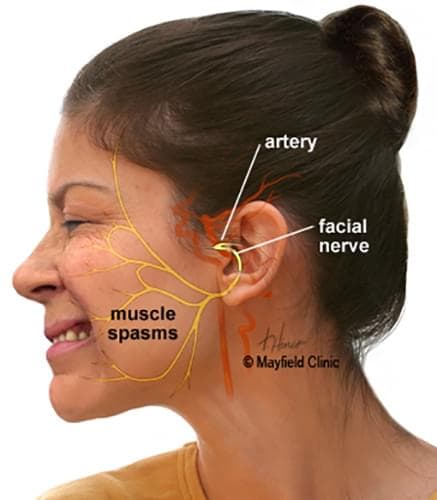 hemifacial spasm diagram