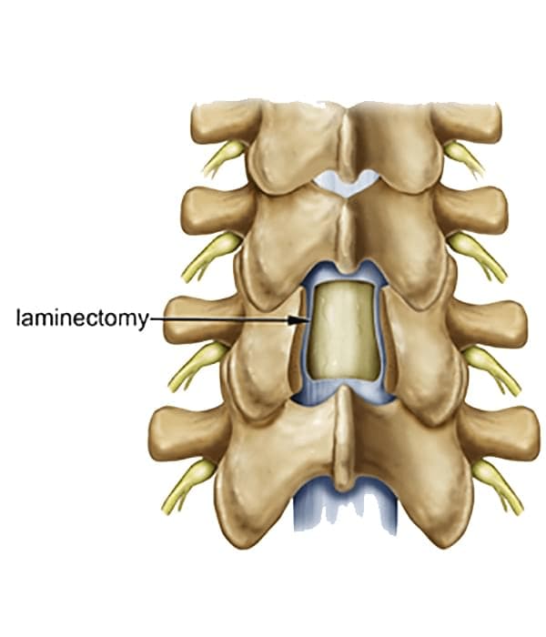 Lumbar Hemilaminectomy diagram of spine