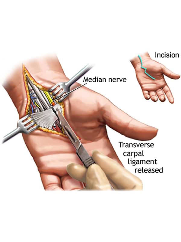 carpal tunnel syndrome symptoms