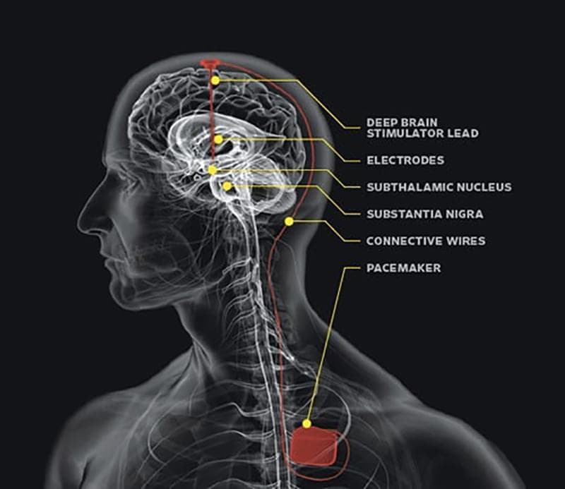 parkinsons disease treatments in tyler, tx