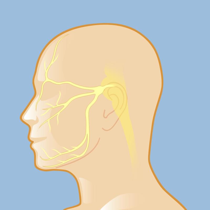 trigeminal neuralgia diagram